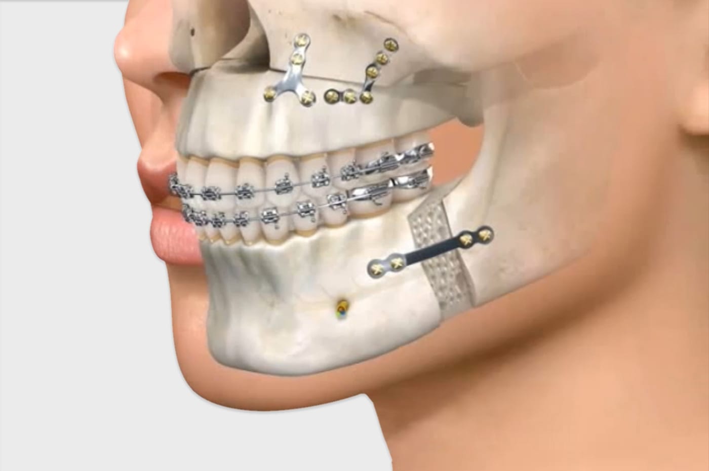 acidente maxilar e mandibula